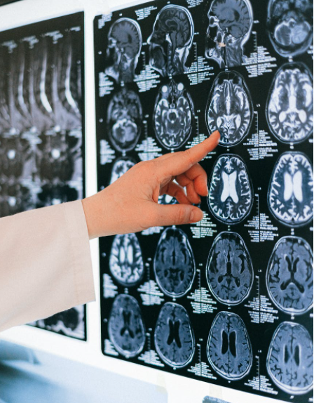 Brain Glue in Treating a Traumatic Brain Injury (TBI)