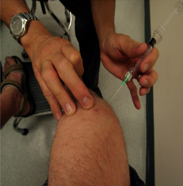 What Are Knee Injections and What Do They Cost?
