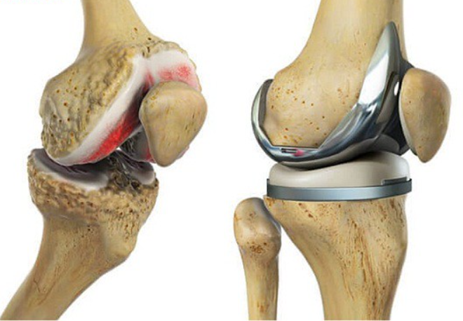 Read more about the article What to Expect When Facing Knee Replacement Surgery